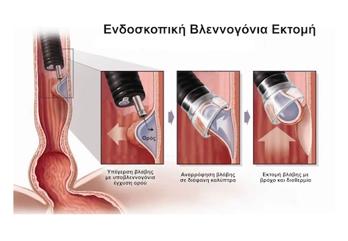 Ενδοσκοπική Βλεννογόνια Εκτομή