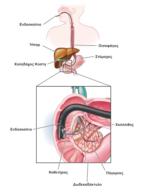 ERCP