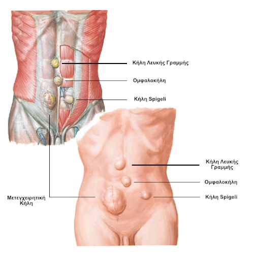 Κήλες Πρόσθιου Κοιλιακού Τοιχώματος
