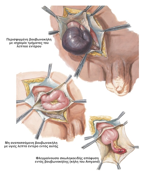 Επιπλοκές Βουβωνοκήλης