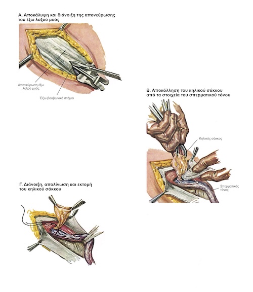 Χειρουργική Αποκατάσταση Βουβωνοκήλης