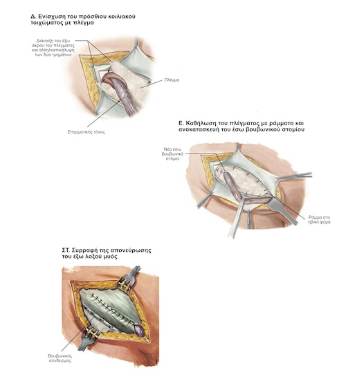 Χειρουργική Αποκατάσταση Βουβωνοκήλης με Πλέγμα