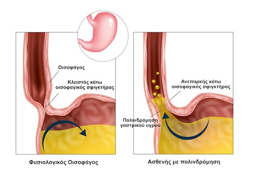 Μηχανισμός Γαστρο-οισοφαγικής Παλινδρόμησης