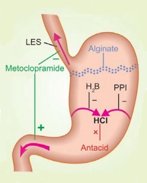 Φαρμακευτική Αγωγή Γαστρο-οισοφαγικής Παλινδρόμησης