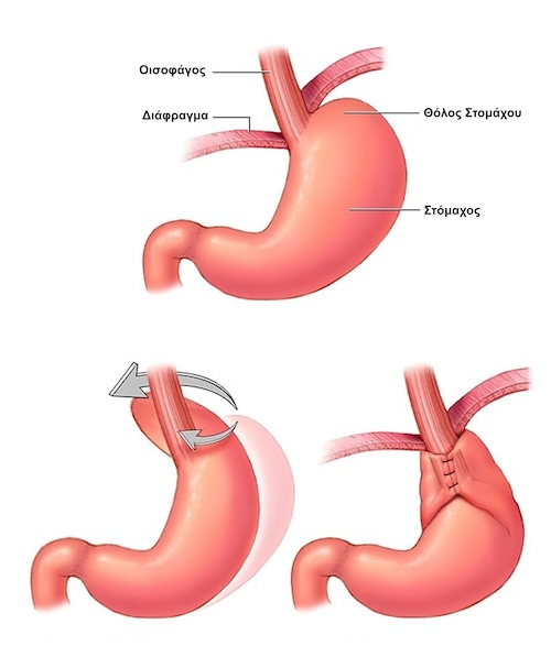 Θολοπλαστική Nissen